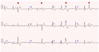 [画像]図1 心電図にて記録された心室期外収縮(赤丸印)。生体内の導電率は臓器により不均一であるため、心電図で計測される信号はゆがみをもちます。その一方で生体内の透磁率は均一とみなせるため、心磁図で計測される信号は他の臓器に影響されません。