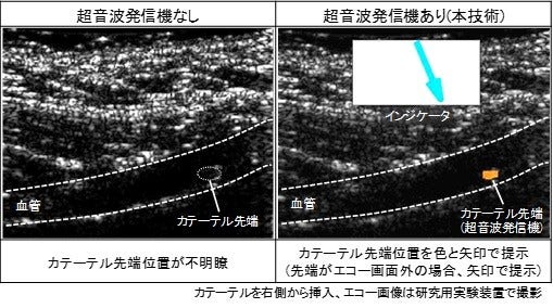 [画像]小型の超音波発信機を用いて、血管内のカテーテル先端位置を検出する基礎技術を開発