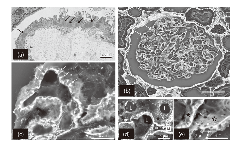 Figure 2 — TEM and Low-vacuum SEM Images of Membranous Nephropathy of the Glomerulus